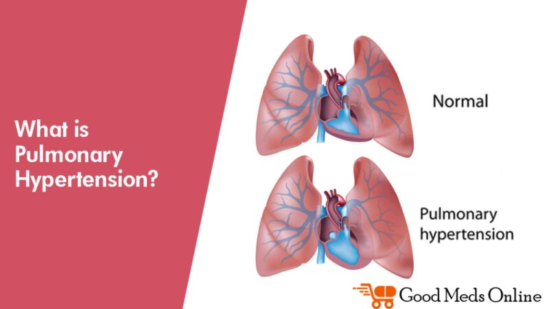Pulmonary Hypertension Symptoms and Medicine For Treatments